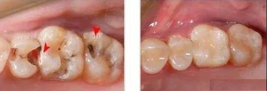 补牙有维护期吗,补牙后该怎样保养