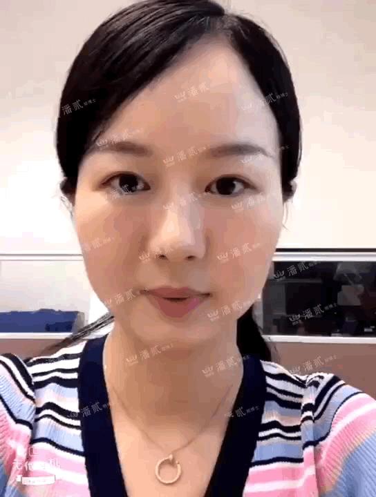 韩式精雕微创双眼皮,韩式微创双眼皮恢复过程真实记录