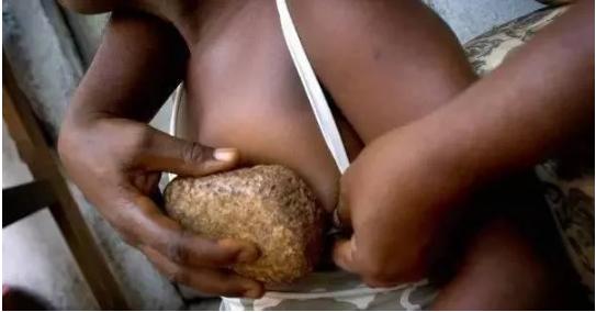 熨平少女胸部!揭秘非洲可怕习俗“烫乳”