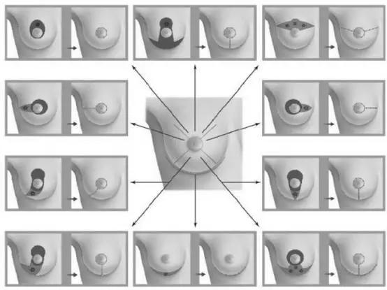 乳腺癌乳房破溃治疗步骤,乳房里肿块怎么动手术