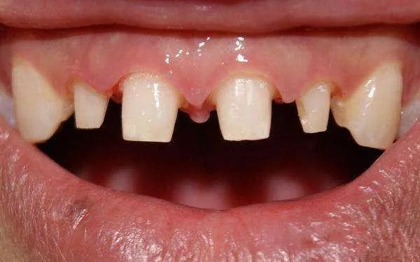 看牙花了2000块钱,看牙花了5000贵吗