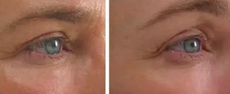 超声刀战胜法令纹原理,超声波祛法令纹有用吗