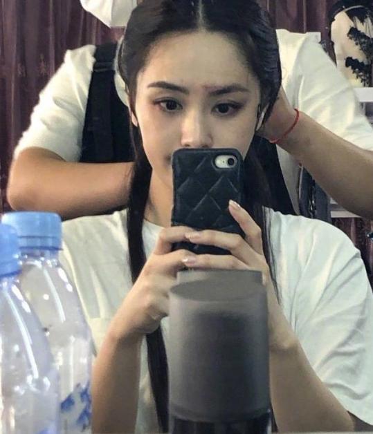 阿娇头部受伤缠绷带照曝光,阿娇受伤后拆绷带首露面