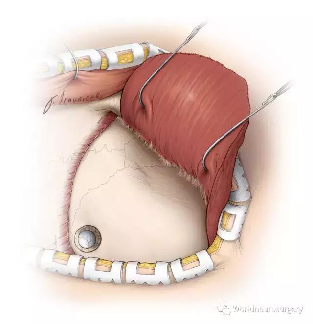 翼点入路技巧图解,翼点入路的开颅要点