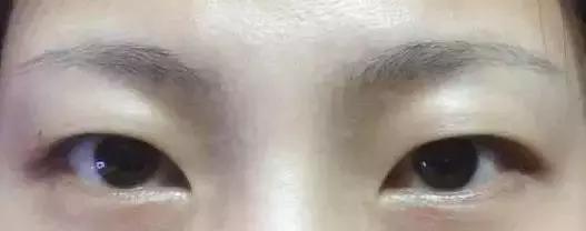 肿眼泡是什么原因啊,肿眼泡怎么贴双眼皮