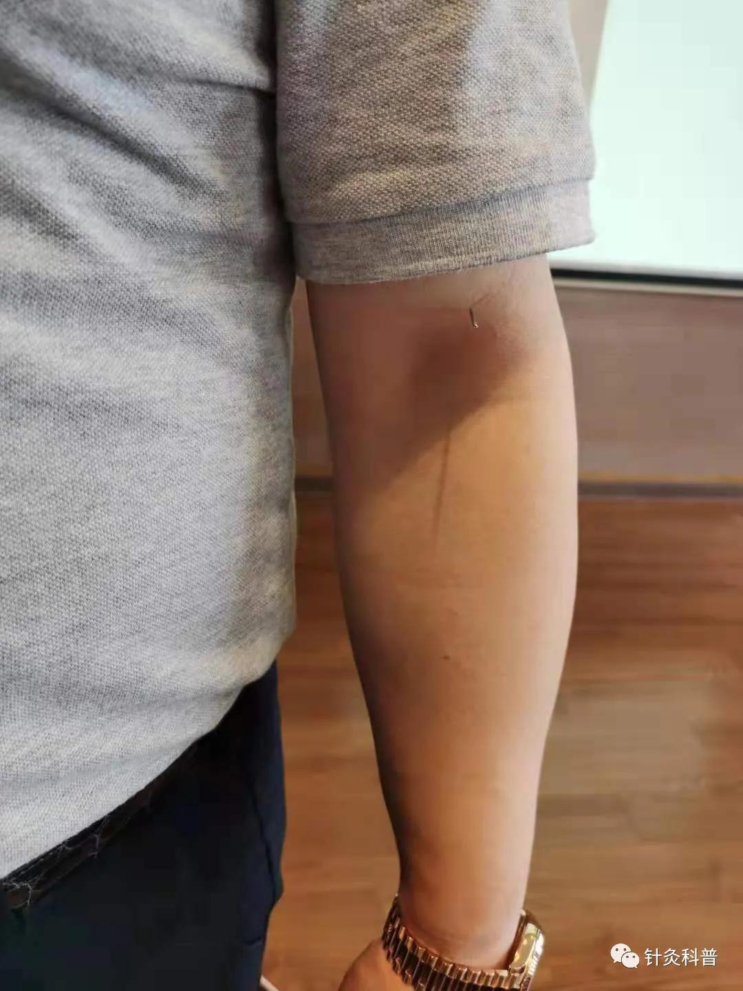 针灸治疗常见疾病方法,伤寒杂病论和针灸