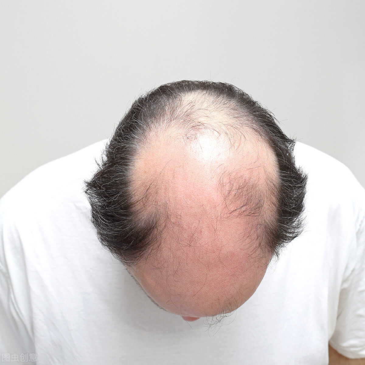 脱发该注意什么吃什么药,脱发有没有好办法治