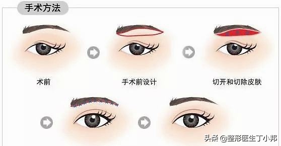 提眉术后注意事项及禁忌,提眉术细节处理