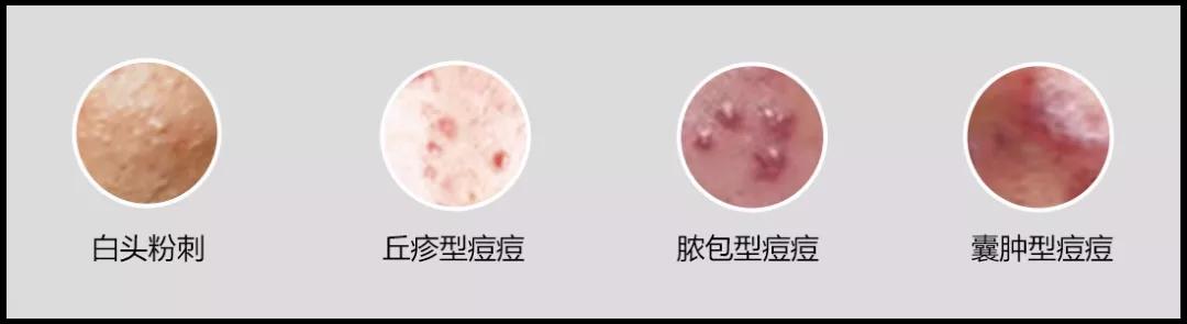 库博士祛痘痘效果怎么样,库博士专业祛痘长沙