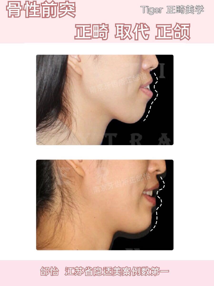 南京成人隐形牙齿矫正一般多少钱,隐适美牙齿矫正比较好的医院