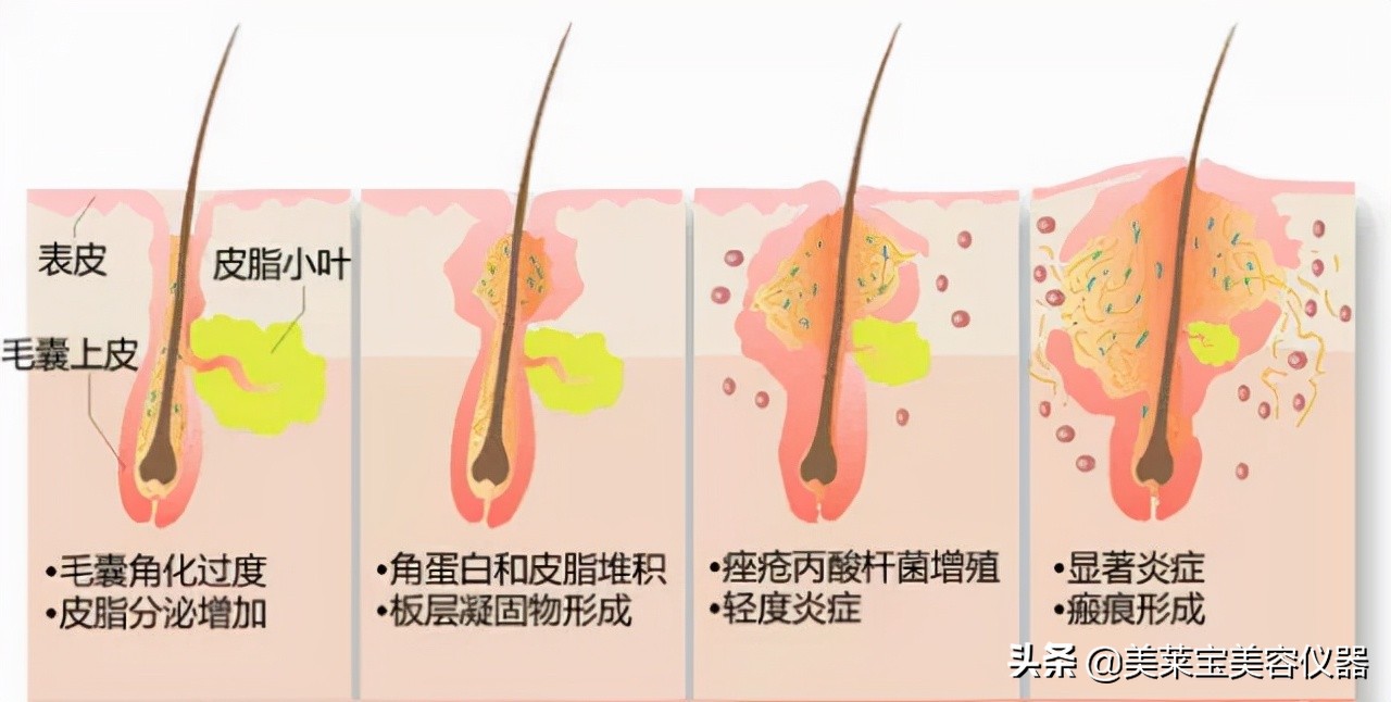 臭氧祛痘仪有用吗,青春痘怎么可以去