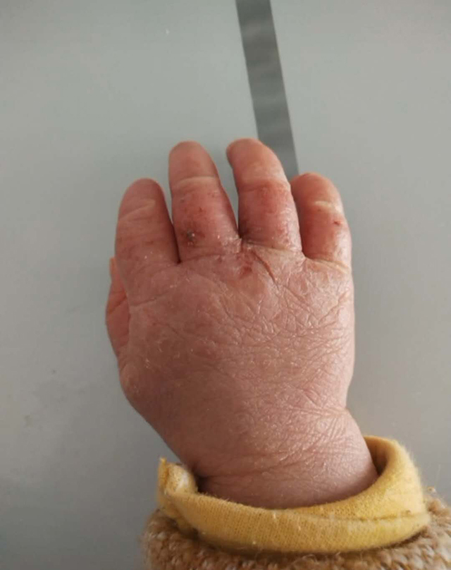 宝宝皮肤粗糙像砂纸怎么办,宝宝四肢粗糙颗粒状怎么回事