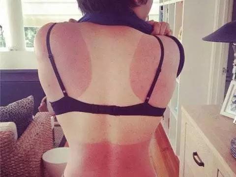 夏天祛晒斑最快的方法,夏天悄悄过去留下了小秘密