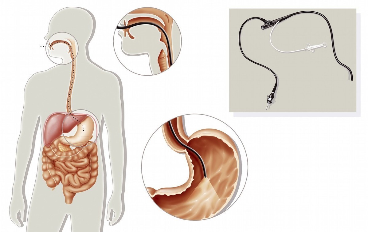 总打饱嗝怎么回事胃镜查着没事,胃疼还打饱嗝要做胃镜吗