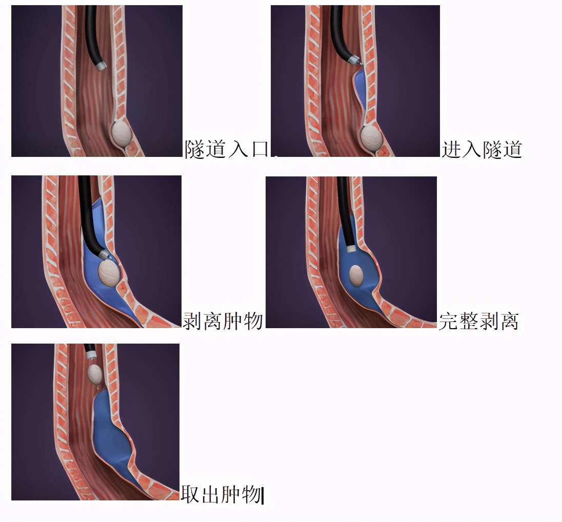 粘膜下开隧道精准切除两个肿物哈医大一院消化内科专家为食管多发粘膜下肿物微创治疗提供新思路