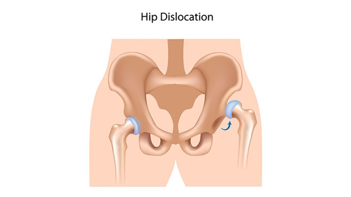 髋关节发育不对称怎么办,腿纹不对称髋关节发育不良