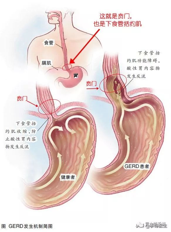 咽炎咽喉异物鼻窦炎一招解决,鼻窦炎后咽炎怎么治疗彻底除根