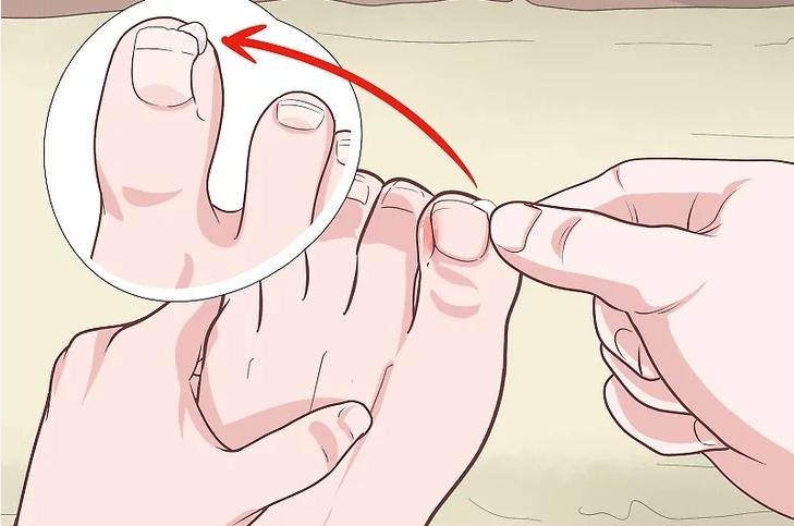 脚趾甲向内生长怎么办?4个小技巧帮你改善脚趾甲内生长