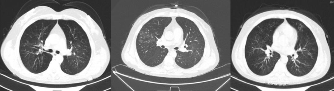 感冒哮喘用药不缓解,吃感冒药诱发哮喘