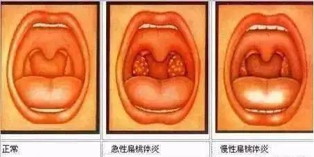 嗓子疼，喝口水都痛？那是因为这个器官出了问题