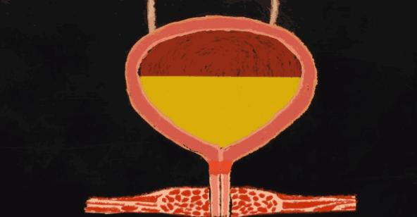 没有了膀胱排尿怎么办？肿瘤科医生告诉你，这几种方法可供选择