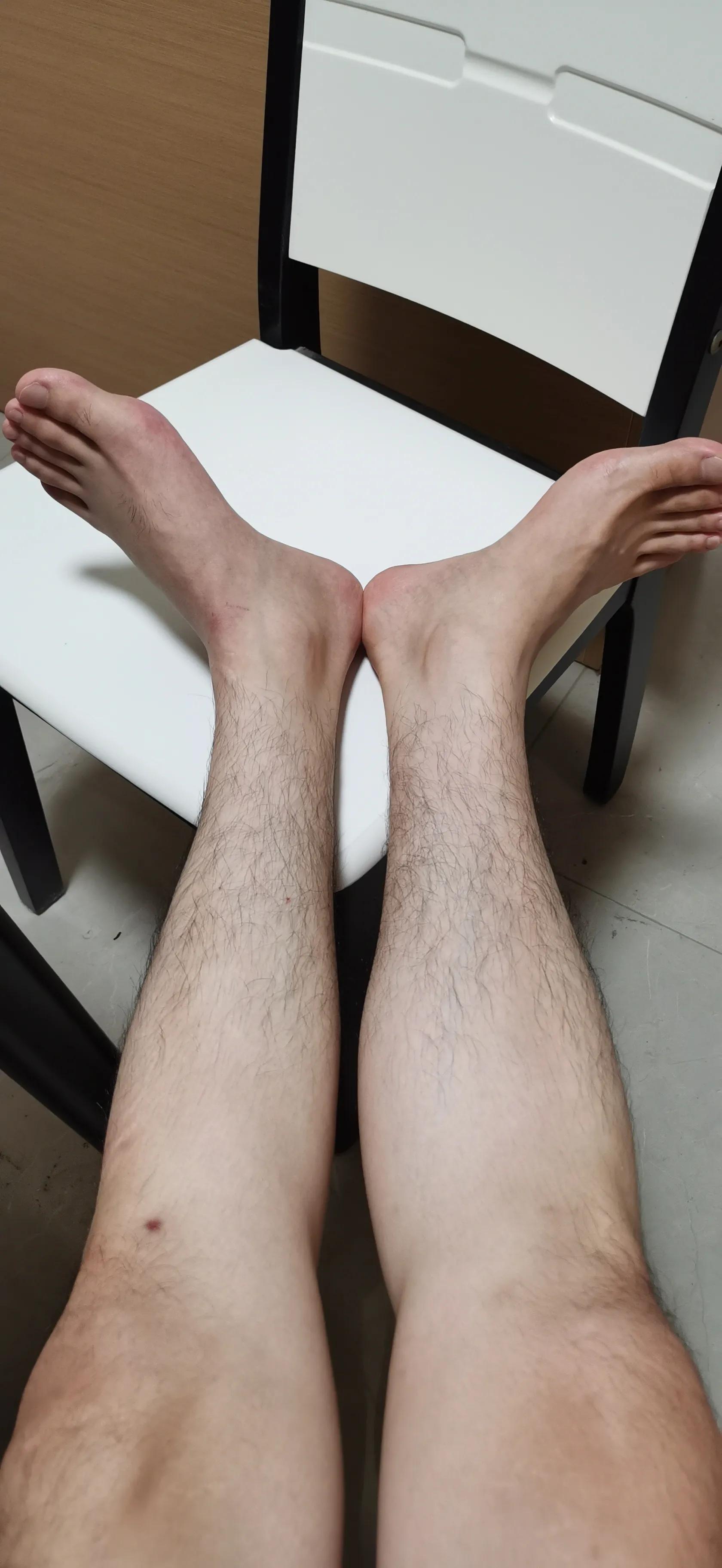 第五跖骨粉碎性骨折多久后能走路,第五跖骨基底骨折100天了走路肿