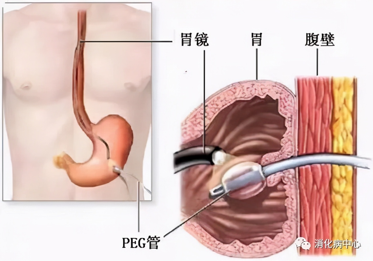 经皮内镜下胃造瘘术操作流程,经皮内镜下胃造瘘术并发症发生率