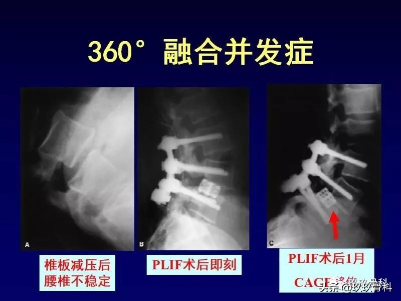 腰椎不稳最坏的结果,腰椎不稳的最佳治疗方法