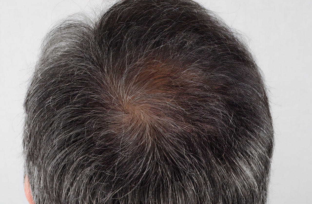 气血亏虚白发多吃什么药好,气血虚引起白发吃什么食物好