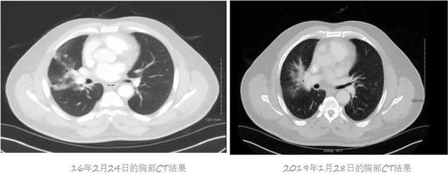 iii期非小细胞肺癌能活多久,iii期肺鳞癌免疫治疗