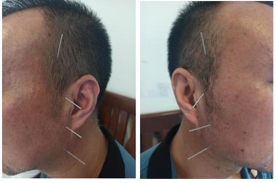 焦虑症引起的胃胀锻炼方法,焦虑症胃不舒服按摩哪个穴位好