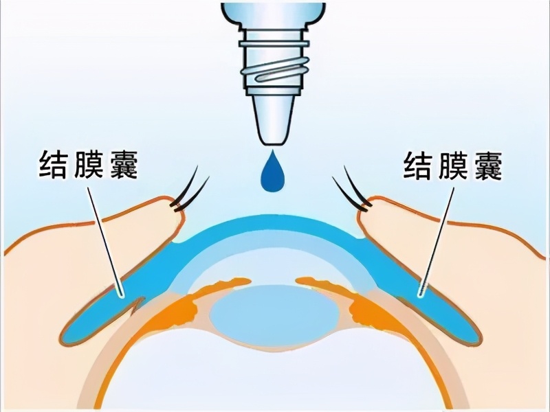 「掌健识」世界青光眼周:青光眼药物治疗之你问我答