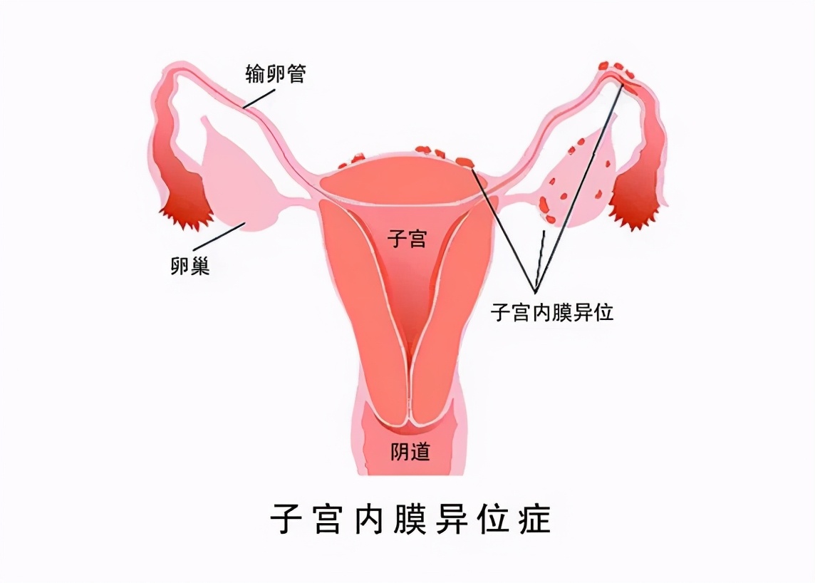 难以忍受的痛经应警惕妇科疾病,痛经难以忍受