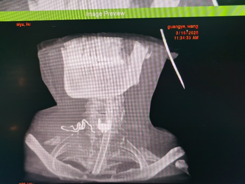 疫情期间颈椎病发作怎么办,疫情间躺久了头昏眼胀怎么治