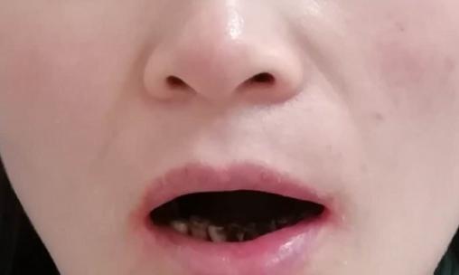 女司机下巴撞护栏情况,女司机撞栏杆下巴脱臼