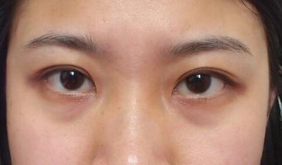 血管型黑眼圈怎么消除,戴眼镜黑眼圈怎么消除