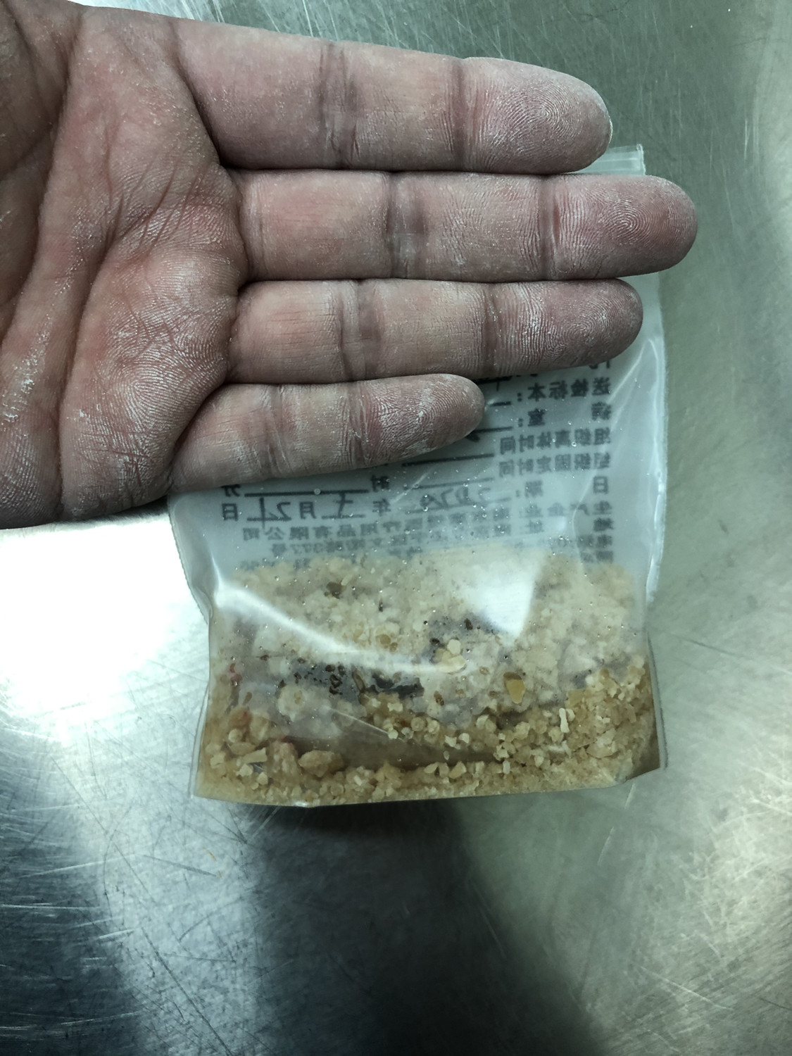 八旬老人患肾结石、输尿管结石专家施行最先进的微创清石术