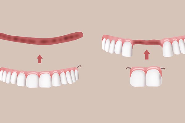 牙齿掉一点怎么补牙,牙齿掉落的补救