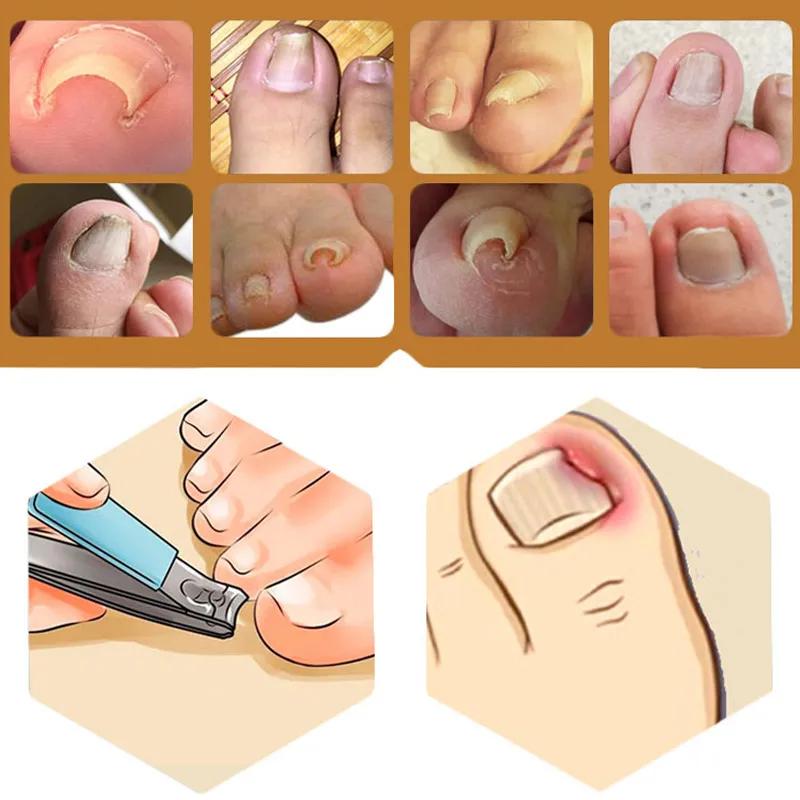 儿童怎么预防甲沟炎,美甲能预防甲沟炎吗