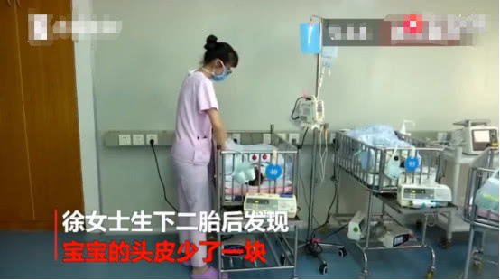 新生儿罕见现象,新生儿天生头皮缺失