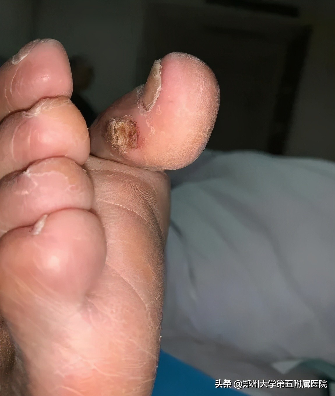 老茧疼痛怎么去除,去除手部老茧