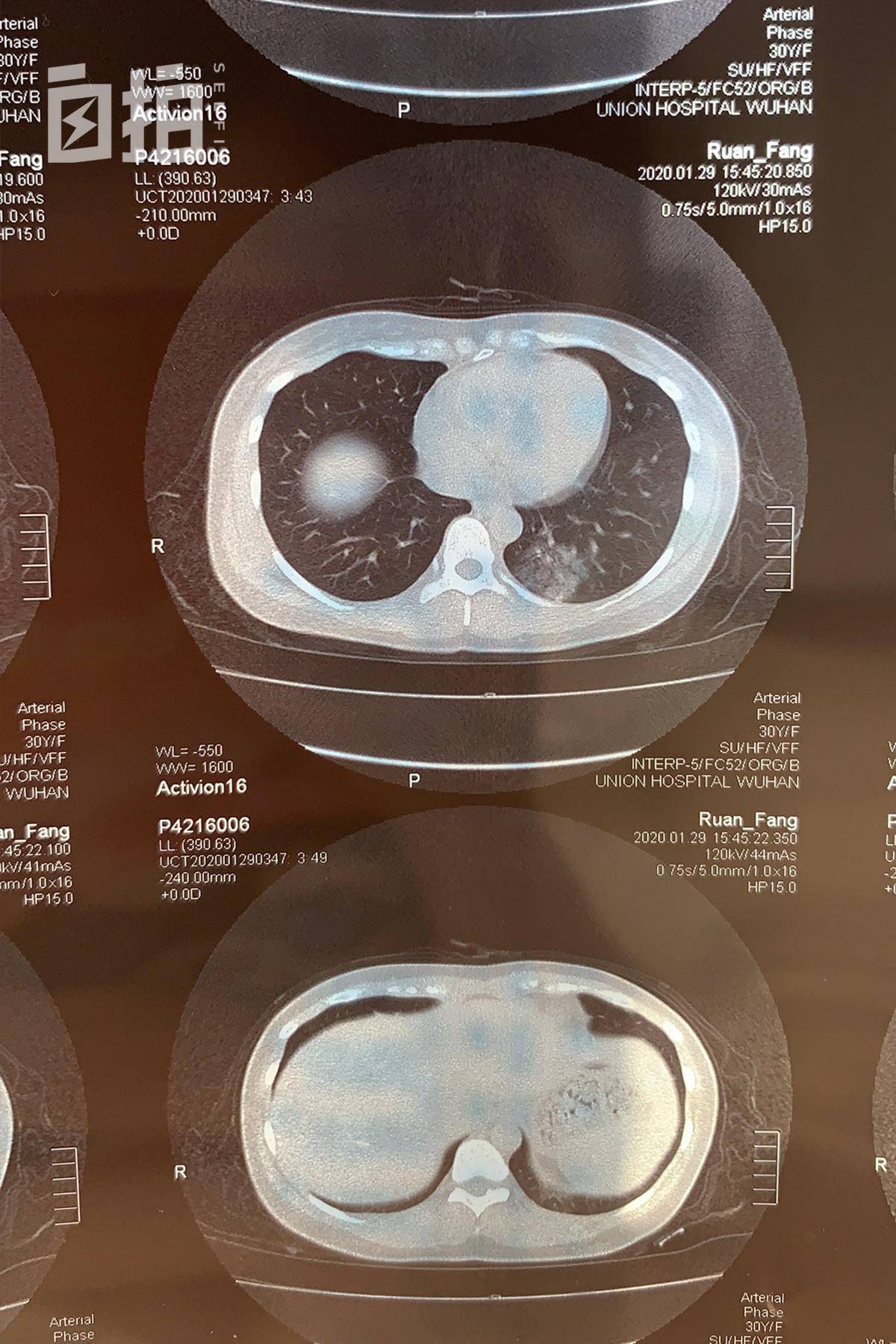 发烧去医院做核酸检测,发烧去医院做了核酸检测