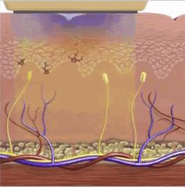 光子嫩肤能去暗沉吗,光子嫩肤反而更紧致
