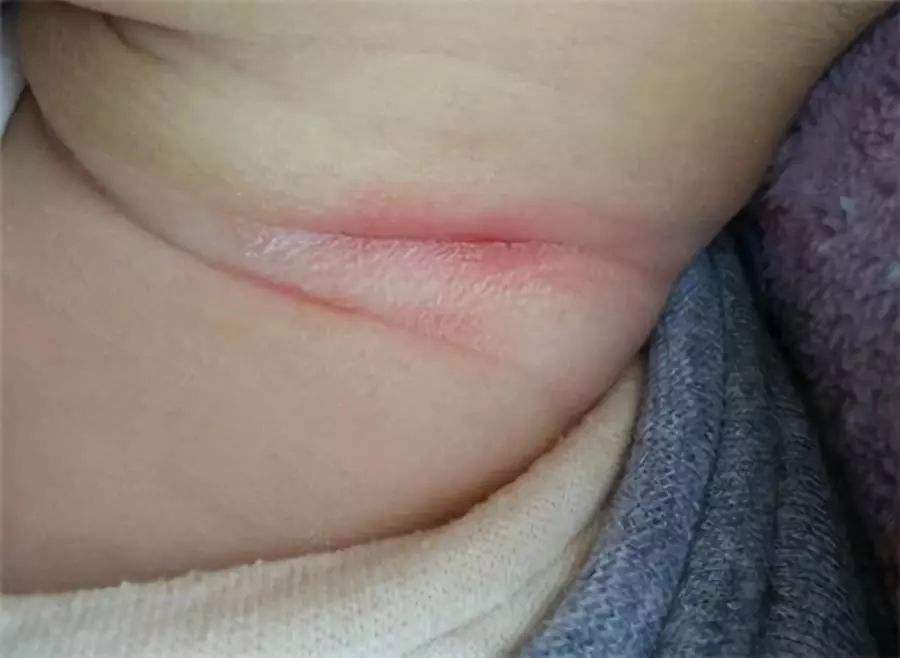 宝宝淹脖子是什么原因引起的,宝宝容易淹脖子怎么办