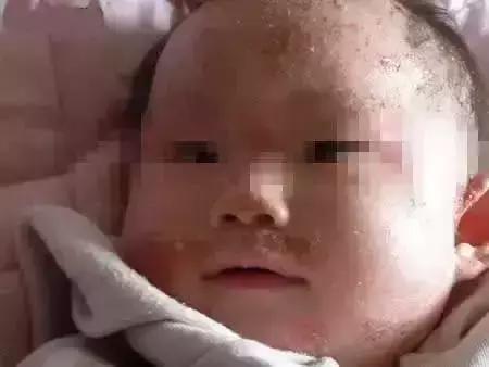 幼儿急疹和痱子怎么区分,宝宝急疹和痱子的区别