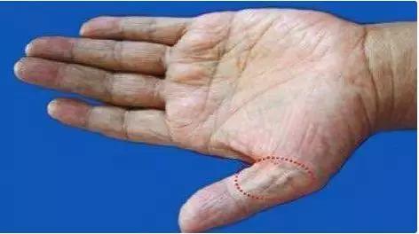 降三高最有效的一味中药,老中医治三高症的特效验方