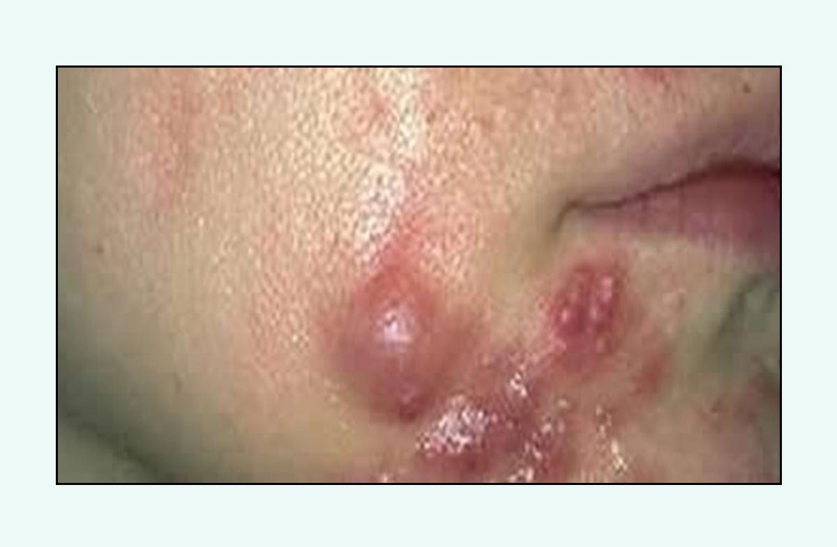 脸上的红疙瘩疼是什么原因,脸上的各种疙瘩