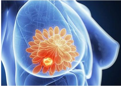 中医王平旦治疗乳腺增生,乳腺增生中医治疗讲解