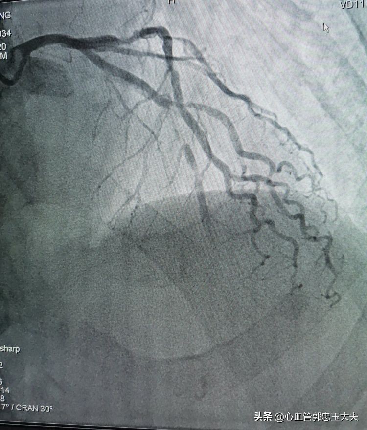 CTO遇到钙化病变怎样才能把血管打通？