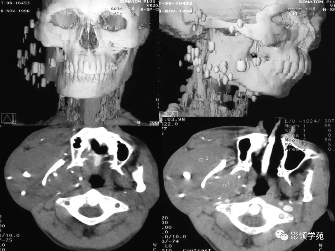 腮腺疾病影像学诊断,腮腺肿块影像诊断